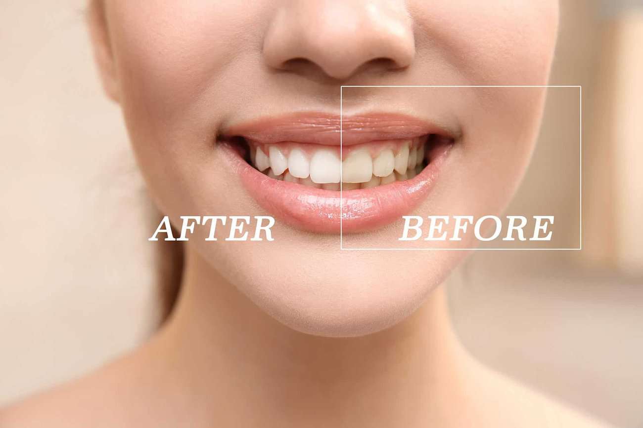 What Are the Most Effective Natural Teeth Whitening Methods You Can Try Bognor Regis?