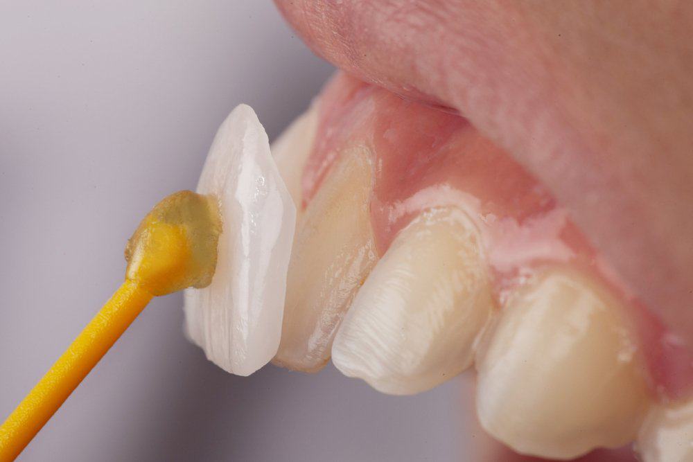 Dental Veneers: Achieving a Flawless Look Bognor Regis