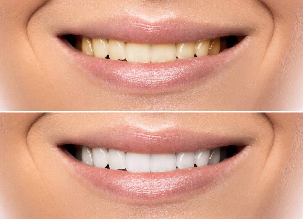 How Does Gum Disease Progress if Left Untreated Bognor Regis?