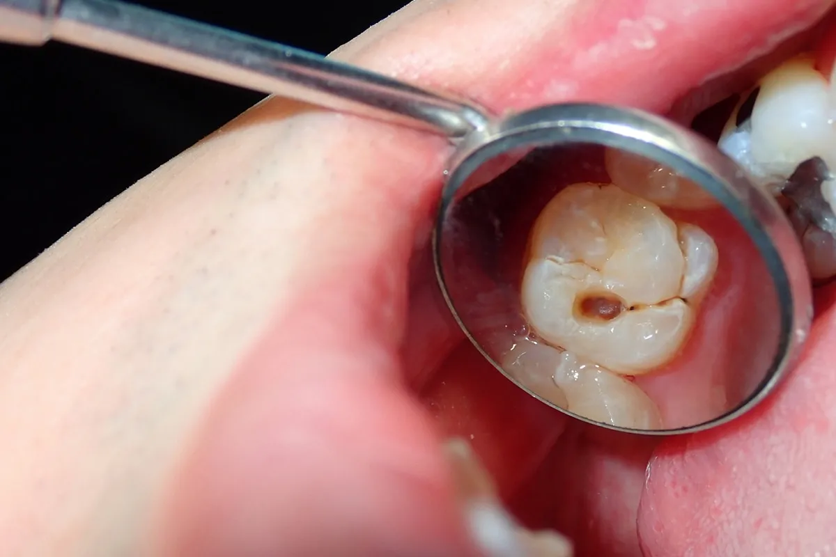 Why Do Teeth Crack? Common Causes to Know Bognor Regis