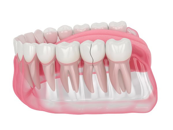 How Can You Manage Pain and Discomfort After a Root Canal Bognor Regis?