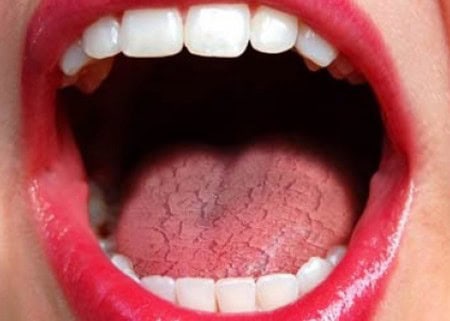 Common Causes of Dry Mouth (Xerostomia) Bognor Regis