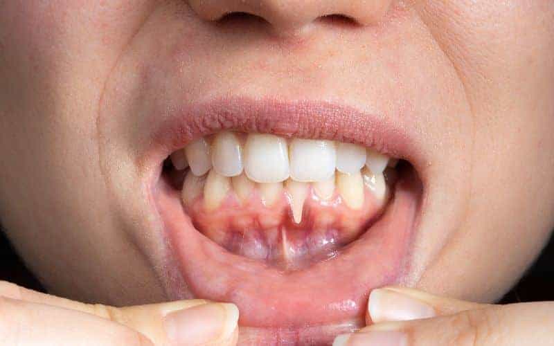How Can Gum Disease Be Prevented Bognor Regis?