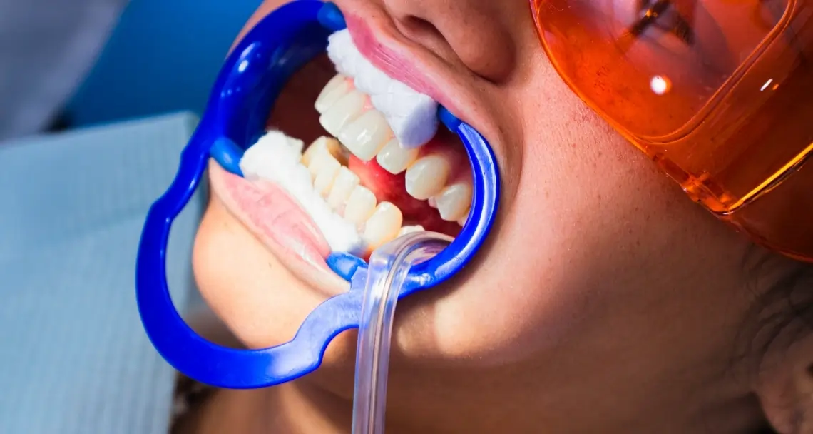 FAQs: Laser Teeth Whitening vs. At-Home Kits Bognor Regis