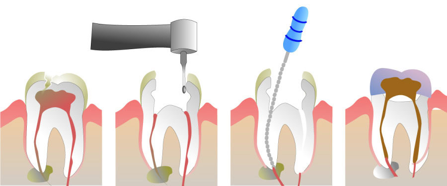 How Do You Properly Care for Your Teeth After a Root Canal Bognor Regis