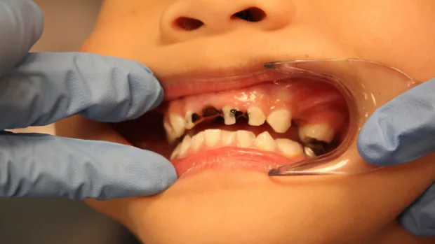 Which Foods and Drinks Cause the Most Damage to Young Smiles Bognor Regis?