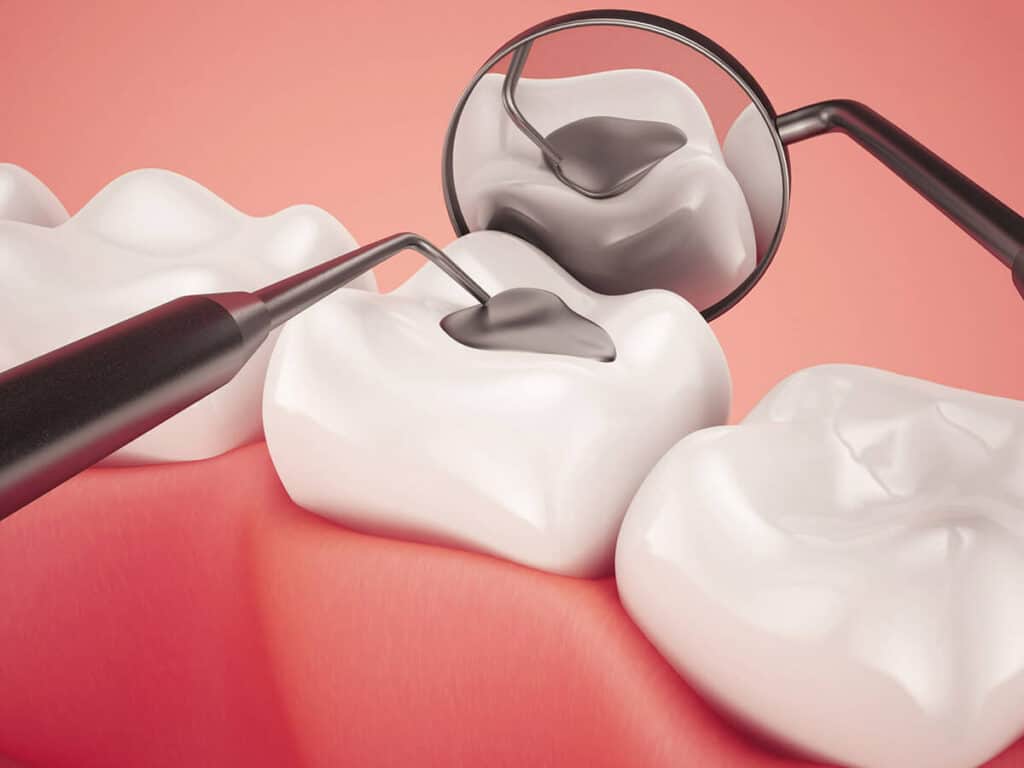 How Can You Prevent Tooth Decay Effectively Bognor Regis