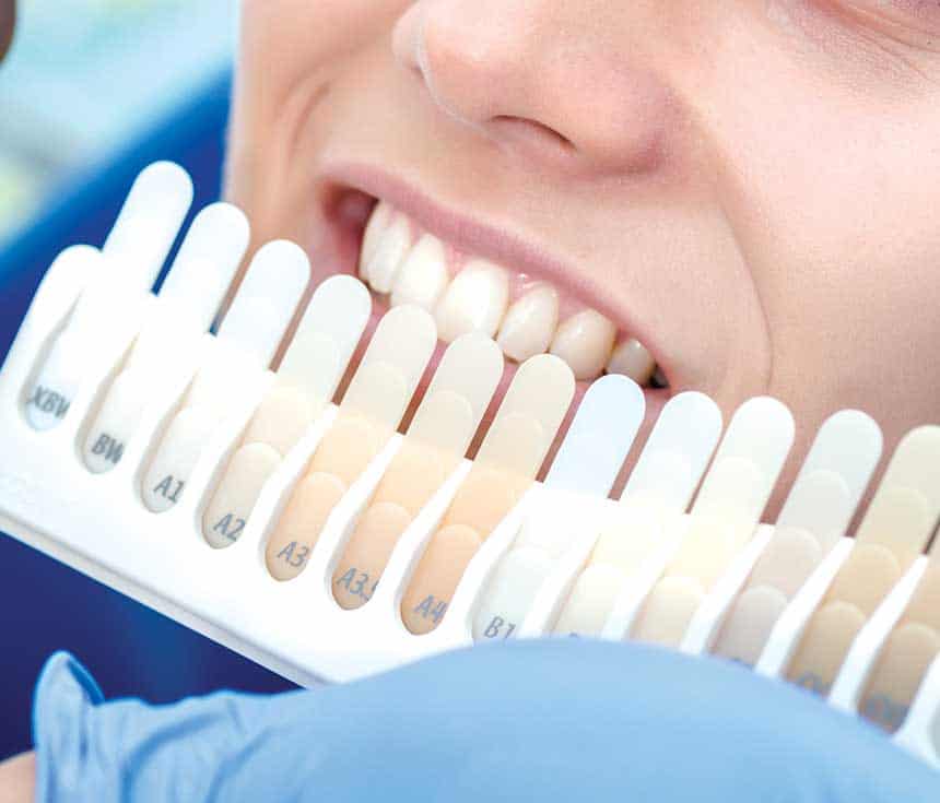 How Much Does One Laser Teeth Whitening Session Cost Bognor Regis?