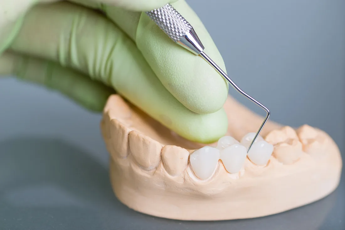 What Are the Different Types of Dental Crowns Available Bognor Regis?