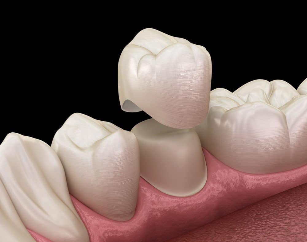 What Daily Habits Help Protect Your Dental Crowns Bognor Regis?