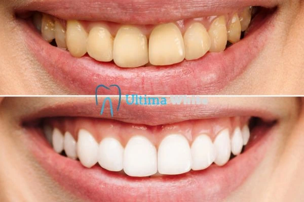 Why Might Multiple Whitening Sessions Be Necessary Bognor Regis?