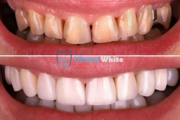 What Makes Instant Teeth Whitening Treatments So Popular Bognor Regis?