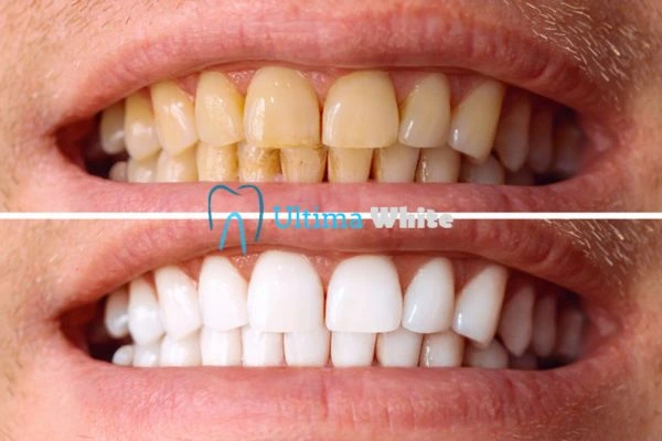 Stained Teeth and Persistent Bad Breath Bognor Regis
